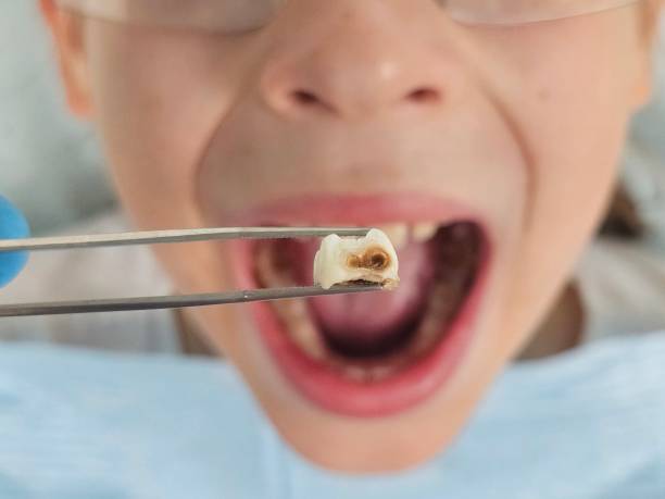Best Dental Abscess Treatment in Vilonia, AR